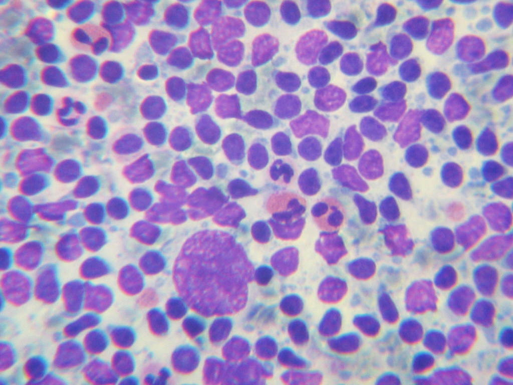 hodgkin cells