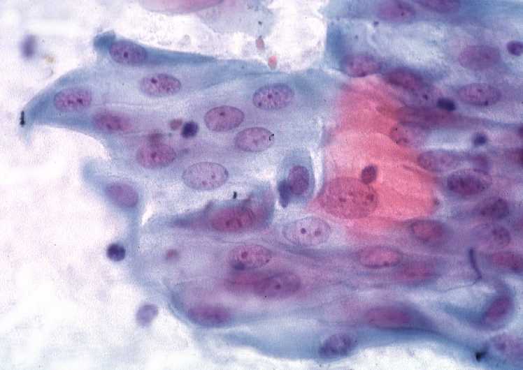 Метаплазированные клетки. Клетки метаплазированного эпителия с реактивными изменениями