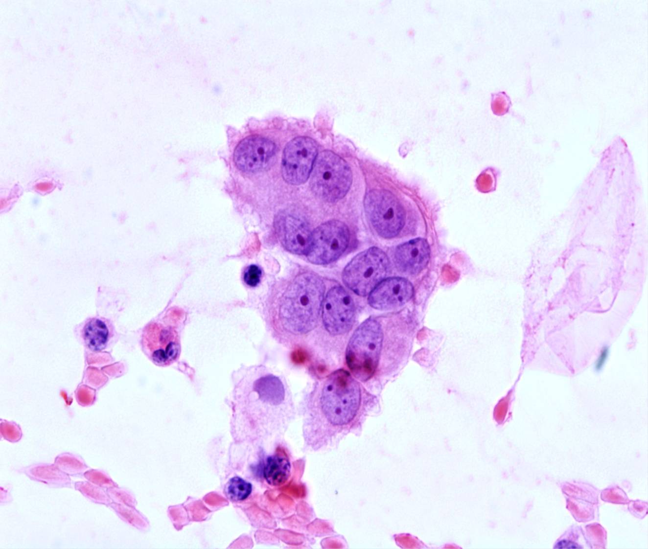 Кашель с розовой пенистой мокротой. Пенистые макрофаги цитология. Альвеолярные макрофаги. Пенистые макрофаги гистология.