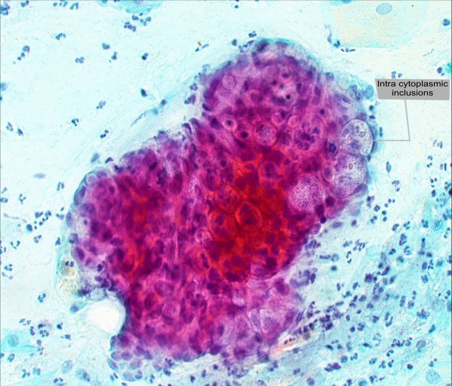 Хламидия в организме. Хламидиоз микроскопия мазка.