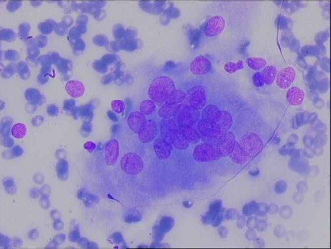 Figure 5: Types Of Multinucleated Giant Cells EClinpath, 55% OFF