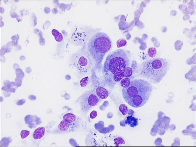 Hurthle Cells Cytology